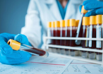 New Rapid Blood Test Promises Faster Stroke Diagnosis