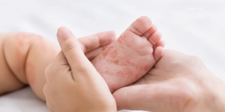 Measles Outbreak Rages in Texas with 48 Cases Identified